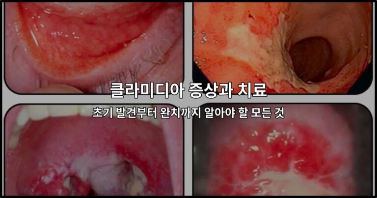 클라미디아 증상과 치료 – 초기 발견부터 완치까지 알아야 할 모든 것
